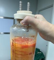 安宁水动力吸脂手术要做多久？